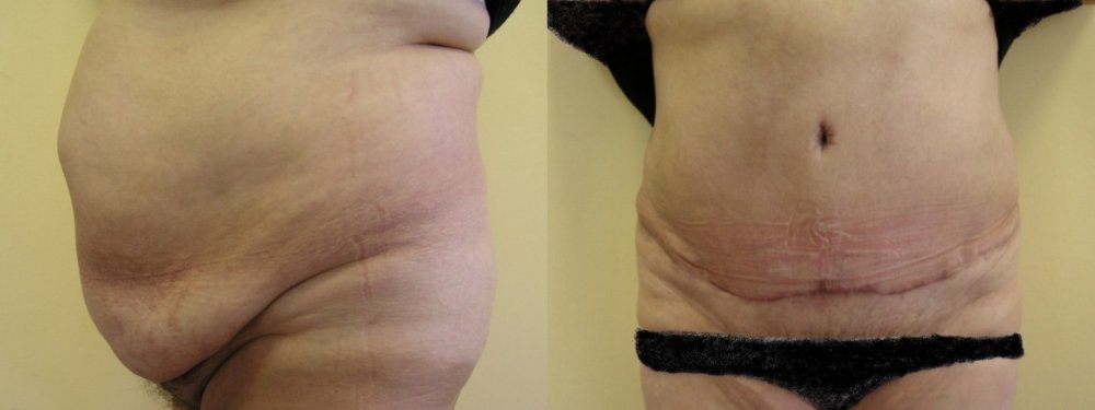 Значительно ожирением живота 2 месяца после операции, шрам исчезнет через несколько недель