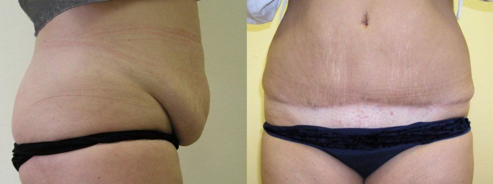 Mäßig adipösen Bauch mit erheblichen Haut Überhang, 22 Monate nach der Operation Narbe hat sich stabilisiert