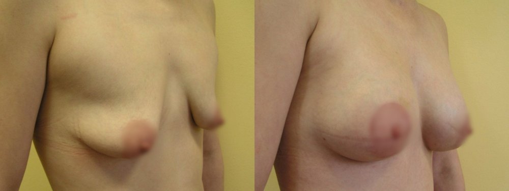 Small breasts with medium ptosis, cut on upper linea of areola, lifting of areola 2 cm, after 4 months and 4 years, good scars and stable shape of breasts