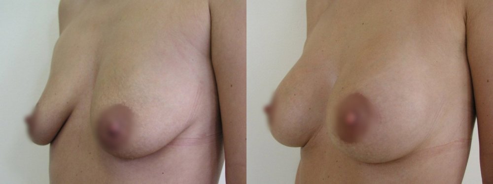 Medium size of breast with medium ptosis, cut on upper part of areolas and their lifting,2 and 8 months after surgery stabilization of scars and breast shape