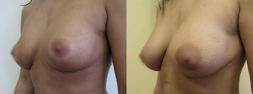 Smaller breasts with little ptosis,cuts in lower linea of areola,is possible to see evolution of shape of breasts and scars 3, 8 and 18 months after surgery