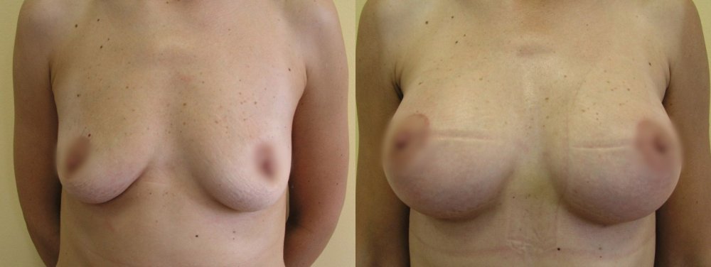 Little loose smaller breasts, cut in upper line of areola, wish bigger volume of breasts, after 3 weeks after surgery