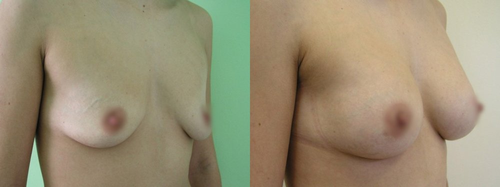 Smaller breasts with little ptosis,cuts in upper linea of areola with lifting 2 cm and natural enlargement of volume, after 2 months good stabilization of breasts and scars
