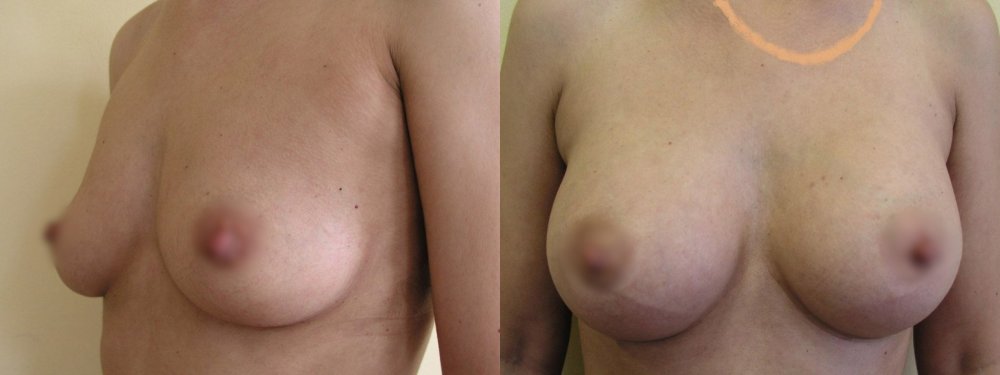 Medium size of breast with small ptosis, the wish of bigger volume of breast, cuts in lower parts of areolas,3 months after surgery are scars only little visible