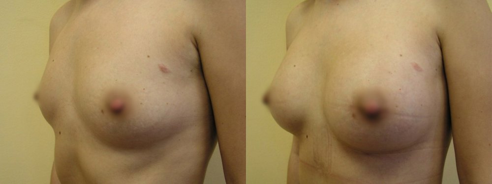 Smaller breasts, little natural augmentation, scars in lower linea of areola,6 weeks and 8 months after surgery