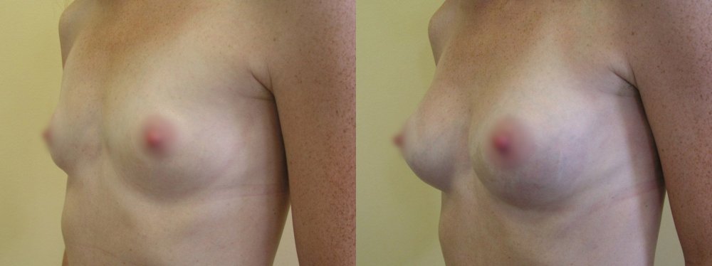 Small breasts - little bit augmentation, overall slim figure, scars on lower line of areola 1 and 9 months after surgery