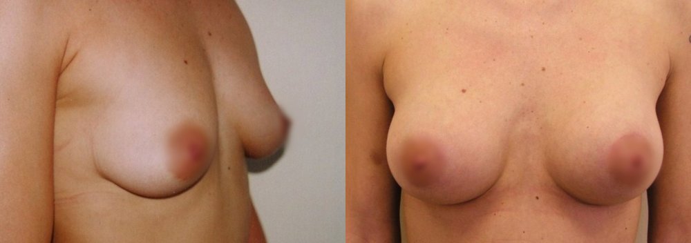 Smaller breasts with little ptosis,cuts in upper linea of areola with lifting 1,5 cm - 2 weeks after surgery