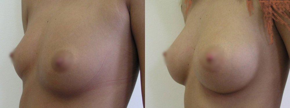 Smaller breasts and wish for little augmentation, scars in lower linea of areola, good shape 1 year after surgery