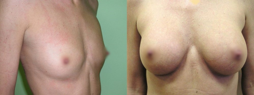 Small breasts- bigger augmentation, scars on lower line of areola, good and stable shape of berasts 3 years after surgery