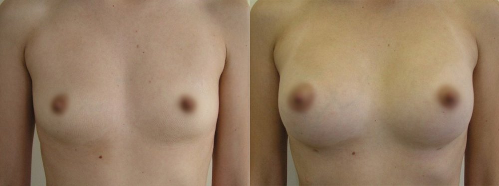 Small breasts - medium- sized augmentation,scars on lower line of areola, 3 weeks and 6 months after surgery with natural shape development