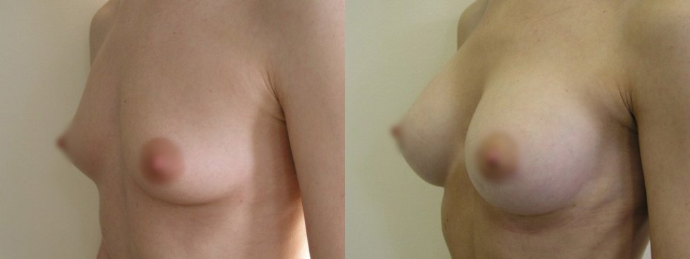 Small breasts - medium- sized augmentation,scars on lower line of areola, 1 and 4 months after surgery
