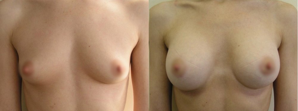 Small breasts - medium- sized augmentation,scars on lower line of areola, 1 and 4 months after surgery