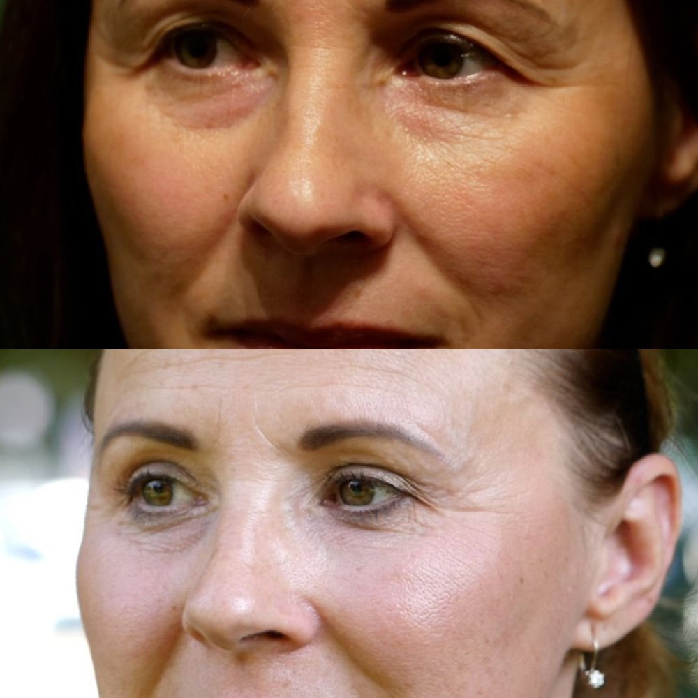 Iveta, Lidstraffung (Blepharoplastik)