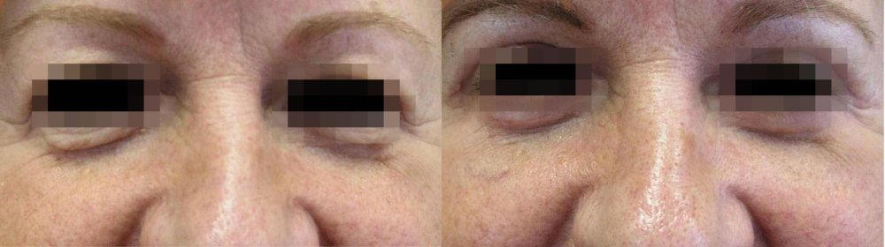 PŘED/PO – Velké kožní nadbytky horních víček zatěžující funkci očí, po 3 týdnech dobrý efekt, kůže již zůstane mírně povolená, operaci bylo vhodné provést dříve.
