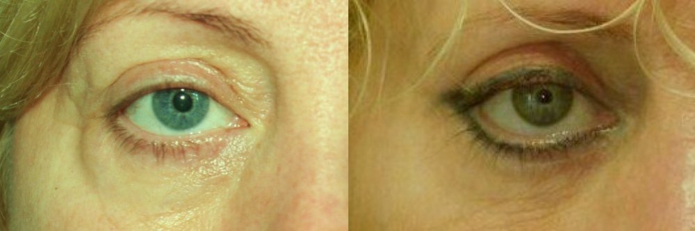 BEFORE / AFTER – Pre-op photo and 4 months post-op photo, scars are hardly visible, lower eyelid skin has smoothed out well after removal of fat prolapse