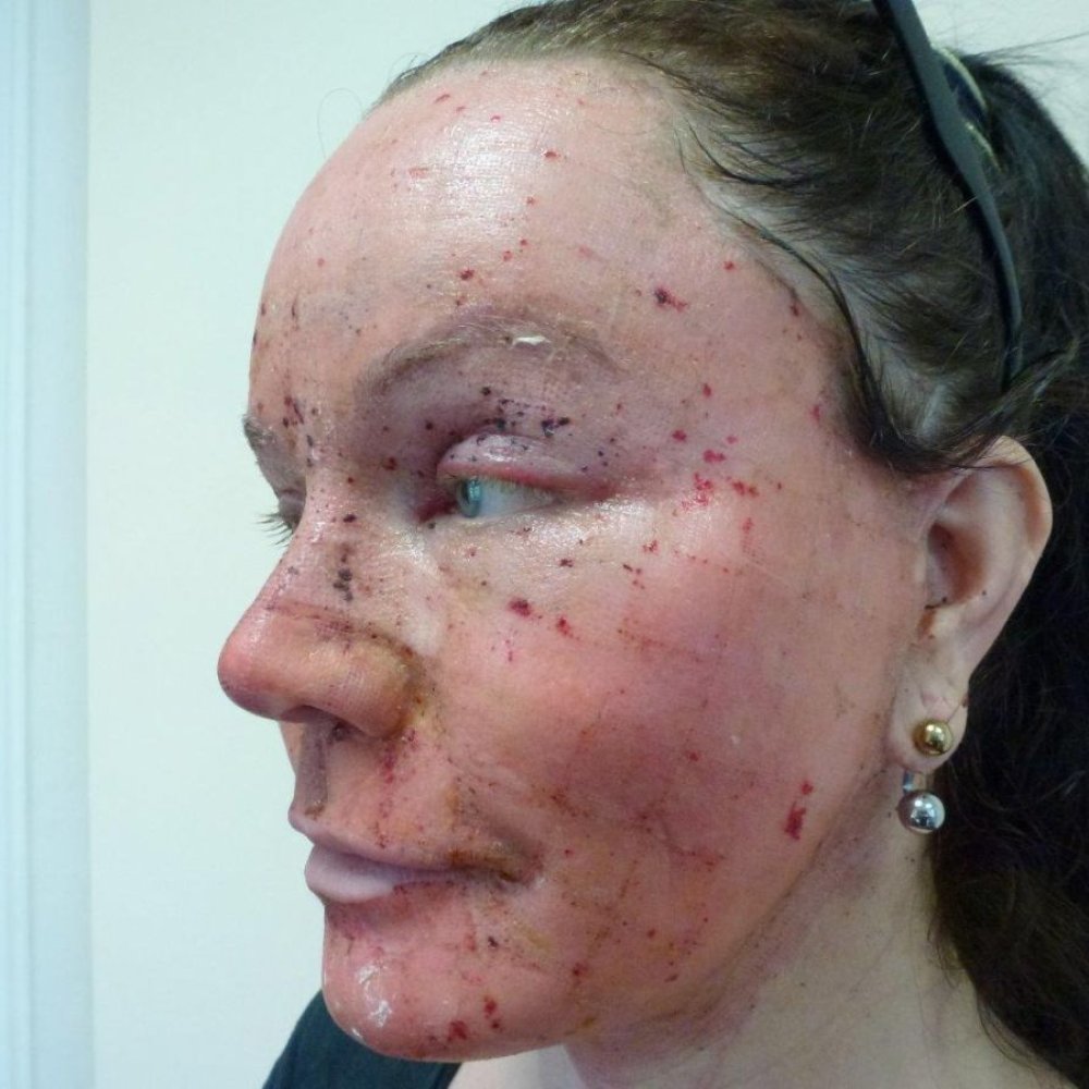 1st day after surgery