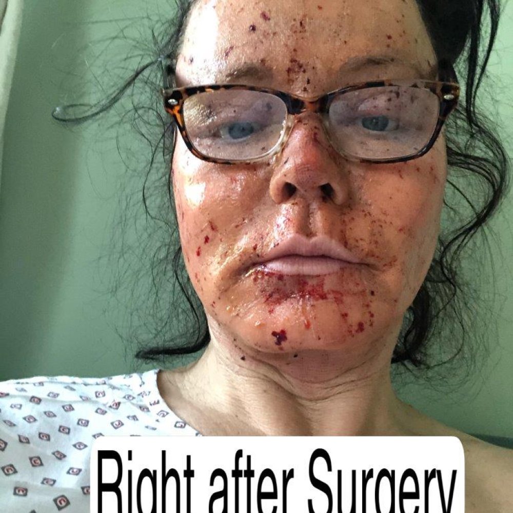 4 hours after surgery