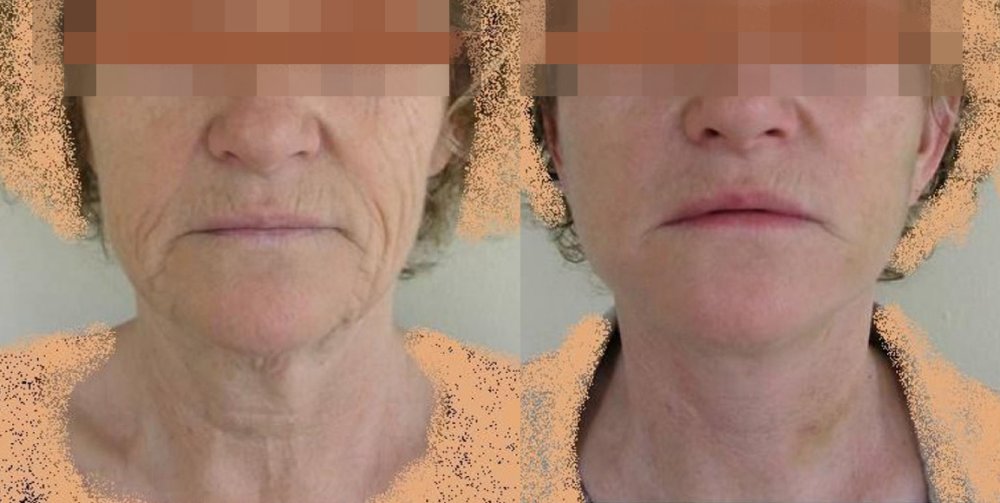 PŘED/PO - obličej s povolenou kůží v dolní polovině a na krku – po 11 dnech efekt již patrný, vrásky na horním rtu je třeba dořešit laserem, operace obličeje zde efekt nemá