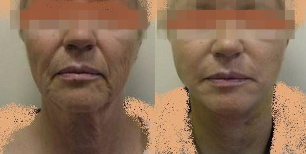 PŘED/PO - obličej s maximem povolené kůže v dolní polovině a na krku, po 10 dnech po operaci již dobrý efekt, na úplné vstřebání modřin je třeba ještě přibližně týden