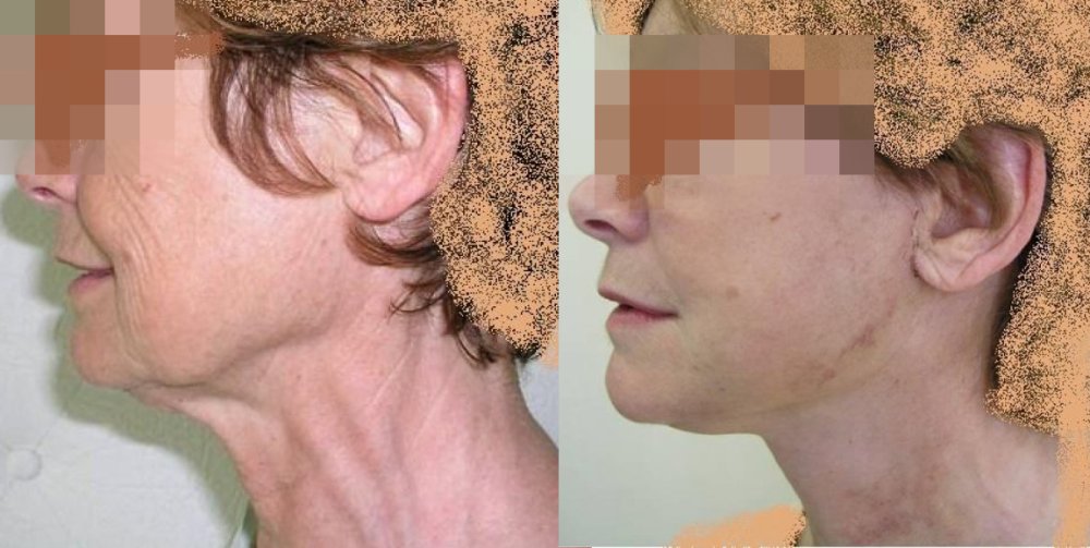 PŘED/PO - obličej s povolenou kůží zejména v oblasti čelistního úhlu a krku, po 11 dnech dobrý efekt, jizvy se hojí dobře, neznatelné budou během dalších 3-4 týdnů