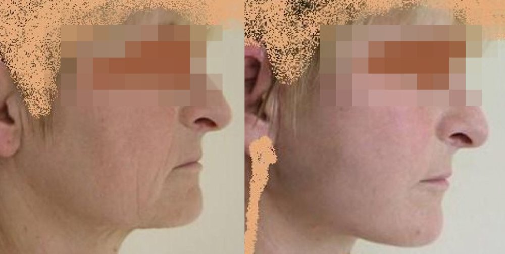 PŘED/PO - štíhlý obličej s povolenou kůží zejména oblasti nosoretních rýh a krku, po 14 již velmi dobrý efekt, hojení jizev dobré