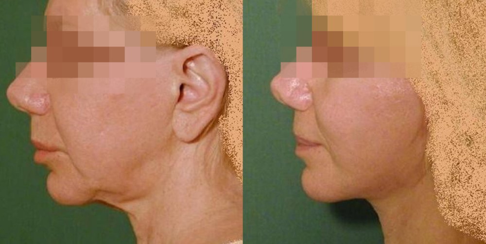 PŘED/PO - patrný pokles tváří a povolená kůže krku, po 3 týdnech již velmi dobrý efekt bez výraznějšího otoku