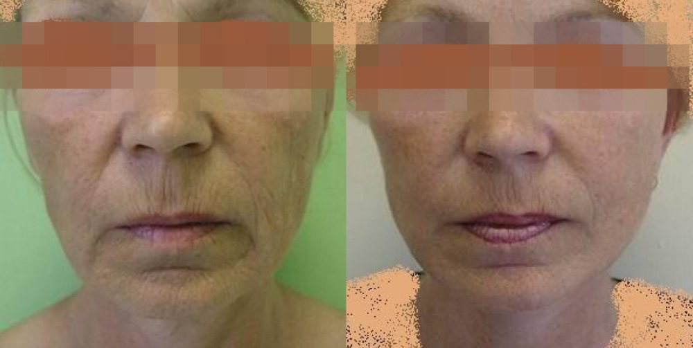 PŘED/PO - povolená kůže zejména tváří a mírně na krku, přirozený a dobrý efekt 1 měsíc po operaci