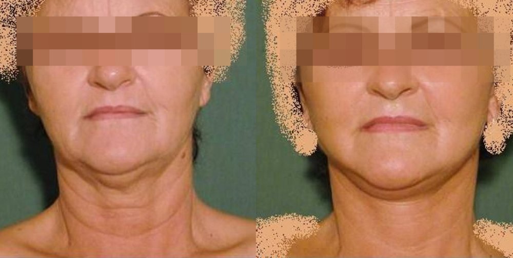 PŘED/PO - mírně povolená kůže obličeje a krku s přirozeným efektem vypnutí kůže 5 týdnů po operaci