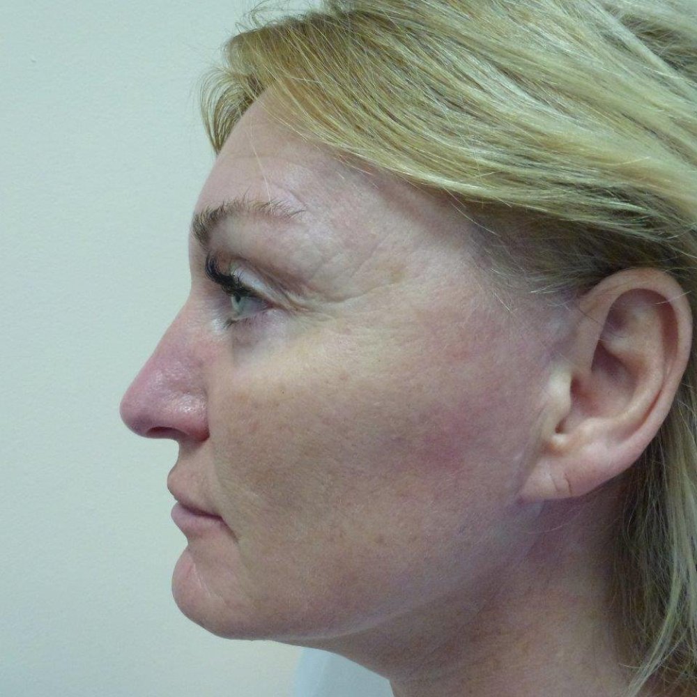 Before fractional laser treatment