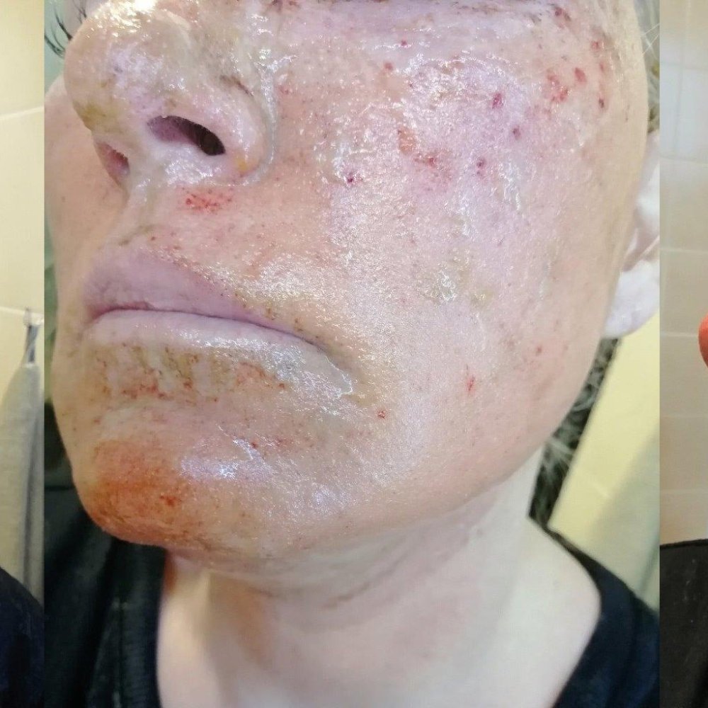 One day after fractional laser treatment