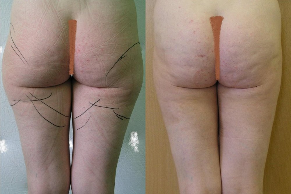 Good effect after 1 month after liposuction of inner and outer thighs