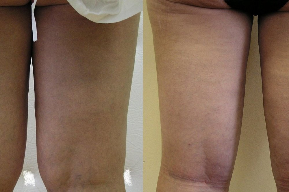 The problem with persistent fat pillow inside parts of knees and thighs,patient in middle age, 3 weeks after liposuction natural and good effect