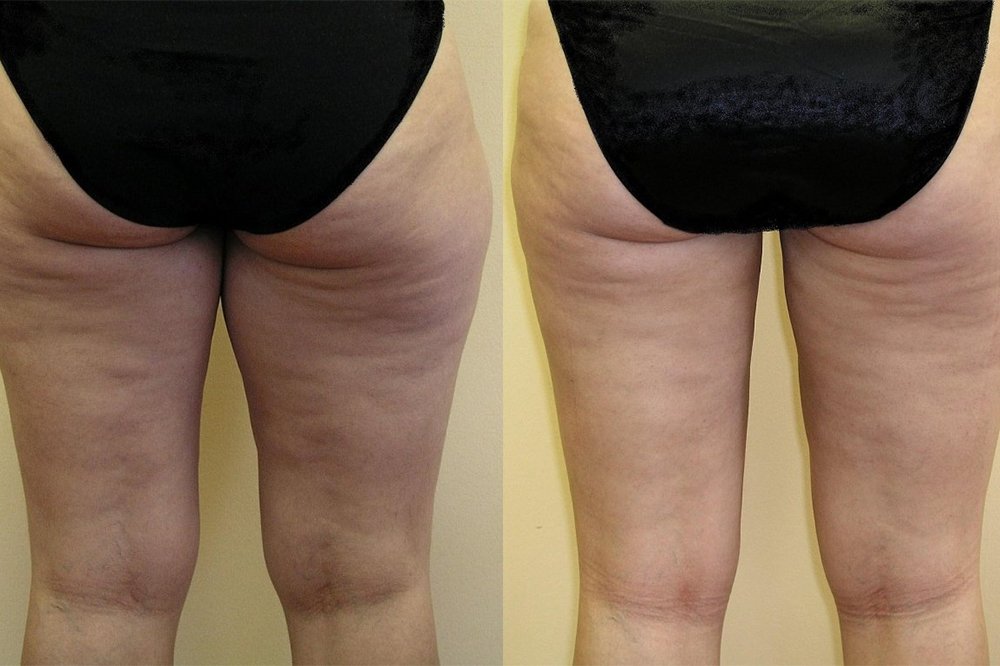 More subcutaneous fat in upper part of thigs, patient in middle age, good effect after 1 month after liposuction