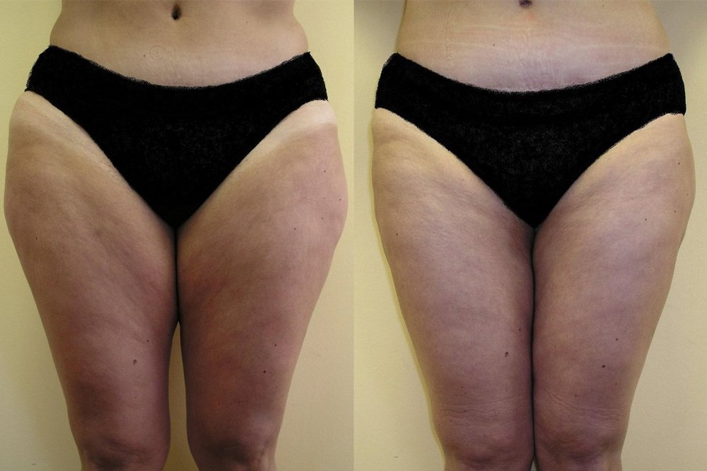 Liposuction of smaller fat pillows on inner and outer thighs, after 6 weeks is good and natural effect