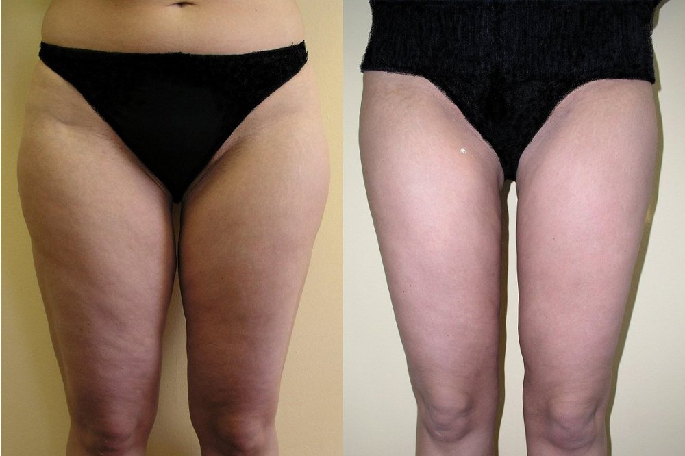 Large hip fat pads upper part of thighs, good visible reduction of volume 1 month after liposuction