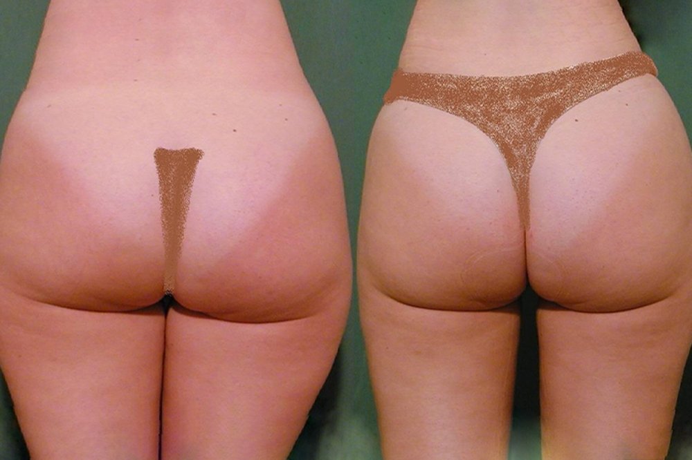 Good reduction of volume from upper part of thighs after 3 months after liposuction
