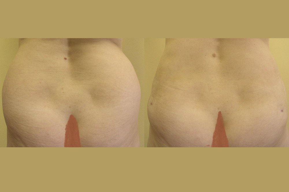Large hip fat pads, 2 months after liposuction visible reduction,inequalities skin and swelling in lower parts will be better after next 1-2 months