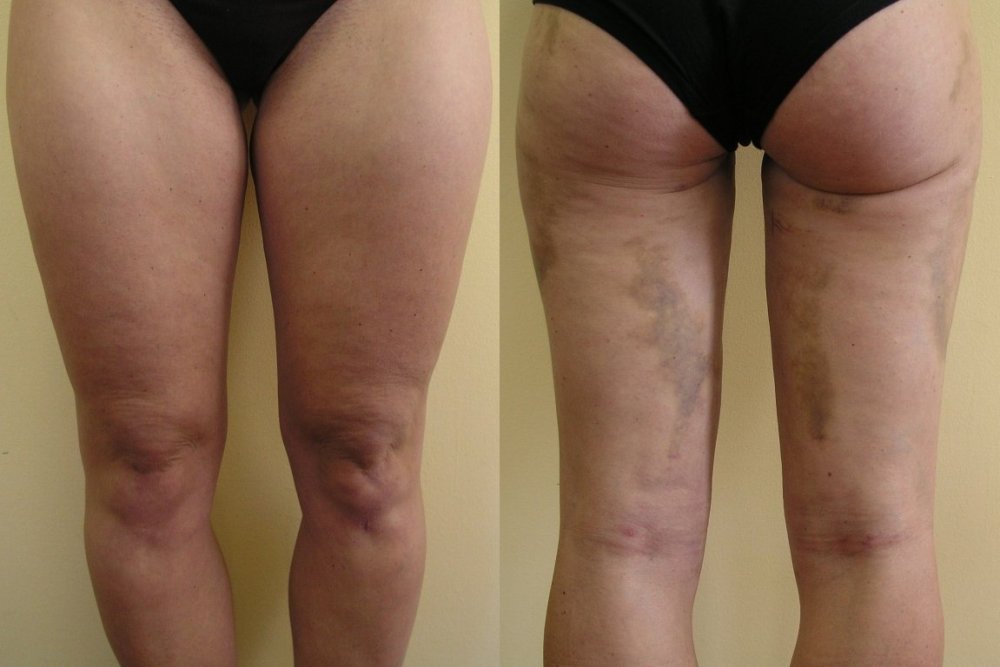 Liposuction of upper parts of thigs – after 2 weeks is good effect on inner and outer thigs, bruises will be still about 2-3 weeks