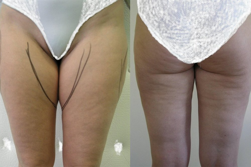 The plane before surgery shows places for liposuction, good effect after 3 months, small wawes of skin before liposuction to stay little also after