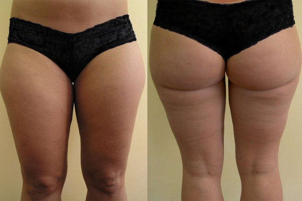 4 months after liposuction bigger layer of fat from upper part of thig, we must be careful, because we can