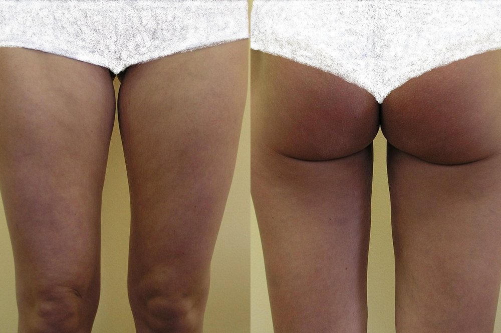 Liposuction of smaller fat pillows on inner and outer thighs, after 6 weeks is good and natural effect