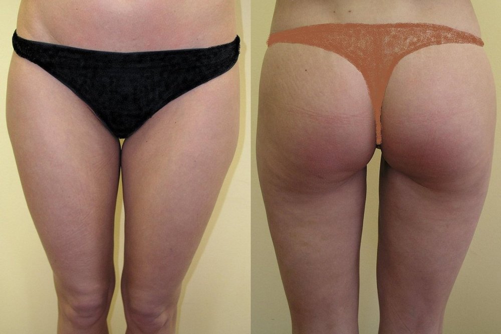 Large hip fat pads upper part of thighs, good and natural effect 2 months after surgery
