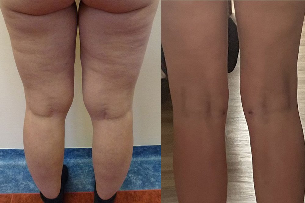 PŘED/PO Liposukce kolen a stehen – foto před zákrokem, 1 den po a 1 měsíc po. Výkon v celkové narkóze, odsáto 2 000 ml tuku. 