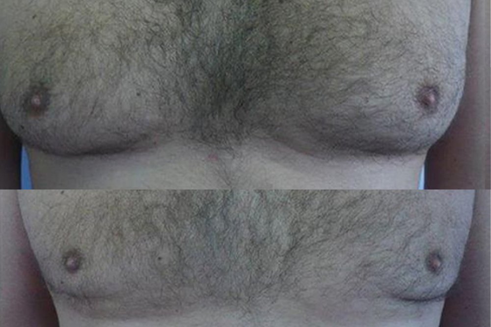 PŘED/PO Liposukce prsou u muže – foto před zákrokem a rok poté. Výkon proveden v lokální anestezii, odsáto 1 000 ml tuku.