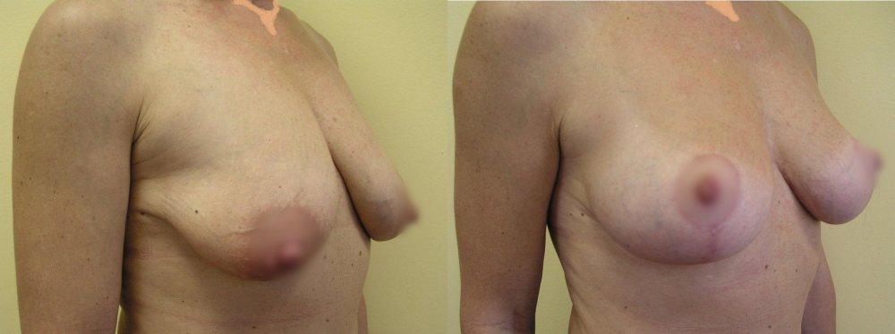 Smaller breasts with ptosis 1 and 3 months after breasts uplifting with gradual stabilization of scars and shape