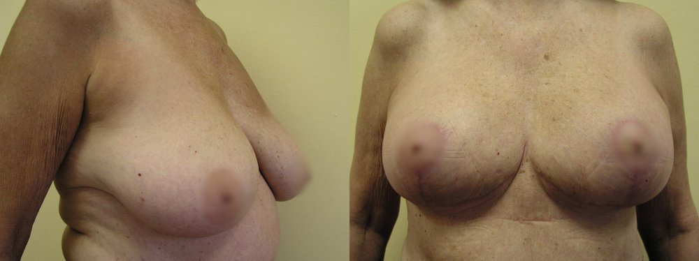 Medium size of breast with ptosis, 6 weeks after medeling and firming
