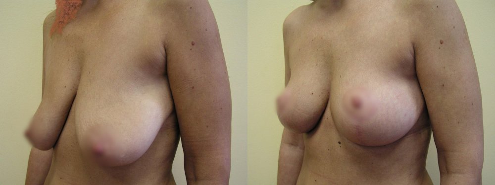 Smaller breasts with ptosis 1 and 4 months after breasts uplifting with gradual stabilization of scars
