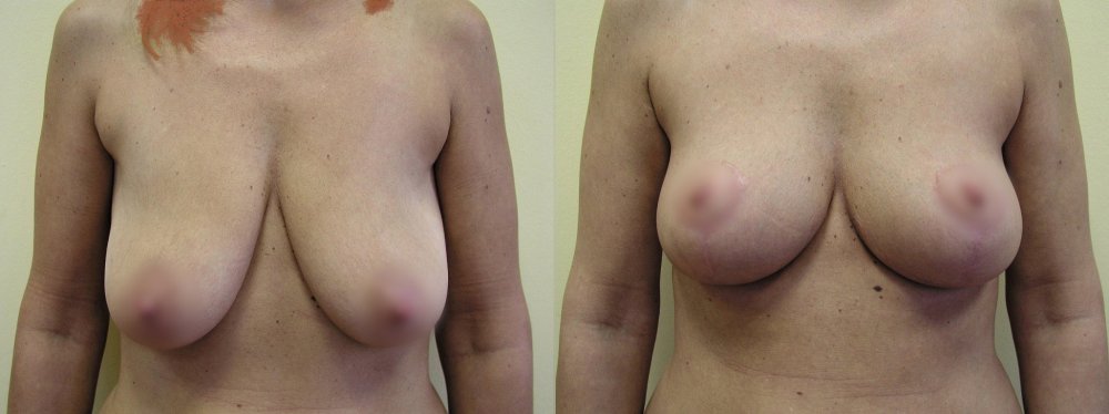 Smaller breasts with ptosis 1 and 4 months after breasts uplifting with gradual stabilization of scars