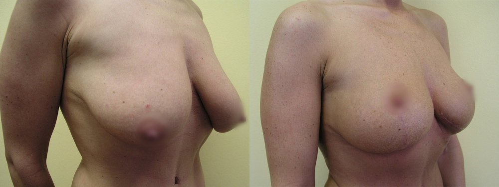 Smaller breasts with ptosis after breasts uplifting with gradual stabilization of scars and shape after 10 and 20 days and than 3 and 6 months after surgery