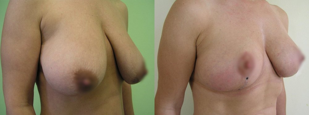 Menší prsy po modelaci a zpevnění 6 týdnů po operaci.